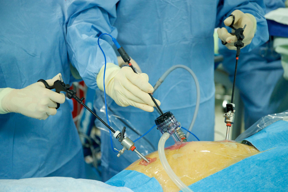 Laparoscopic Surgery